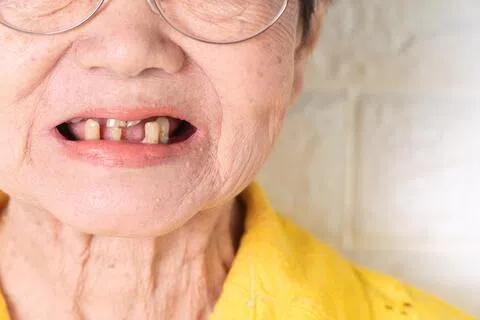 多颗缺牙可能降低咬合支撑、导致舌后坠，增加睡眠时气道塌陷变窄的风险。（iStock图片）